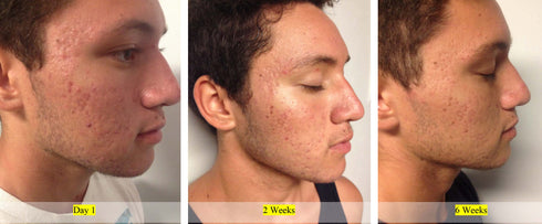Acne Control Serum